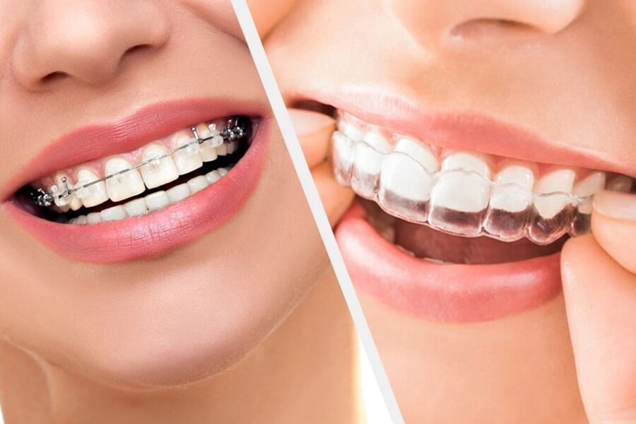 Clear Aligners Vs. Braces