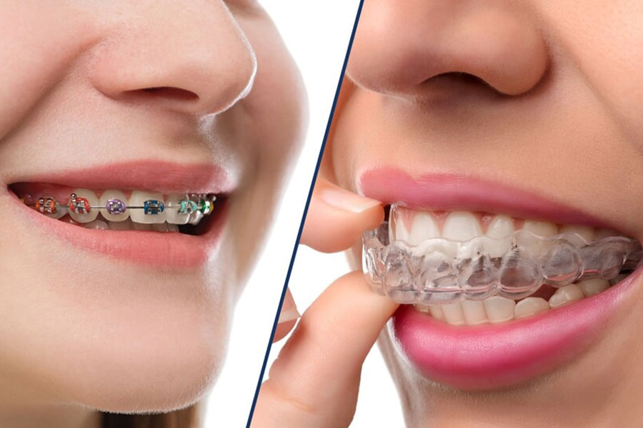 Cost Difference: Metal Braces VS Invisible braces