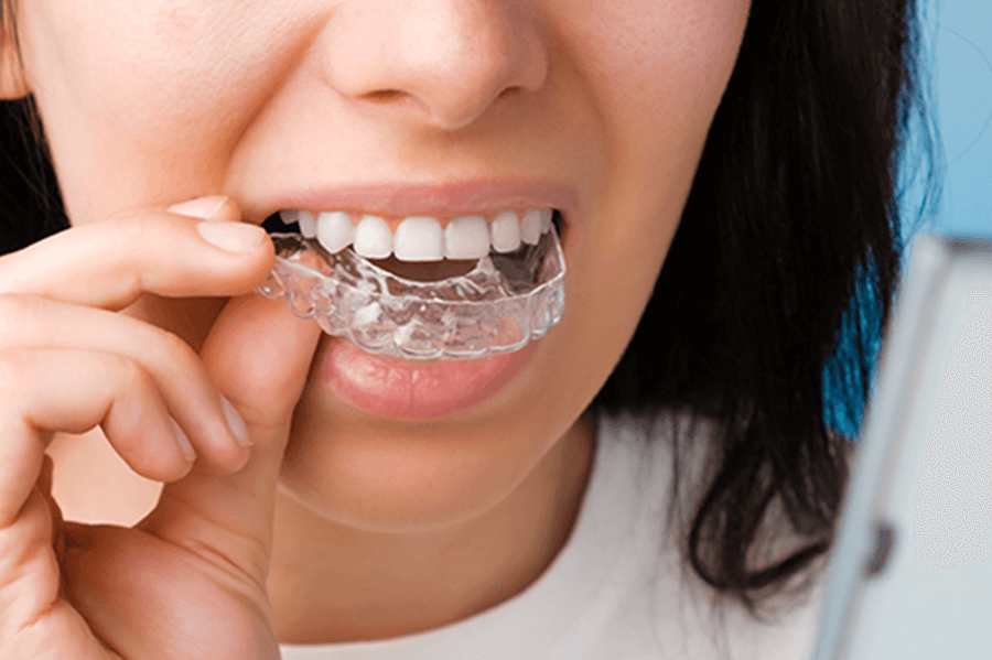 What Are Invisible Aligners And How Do They Work?