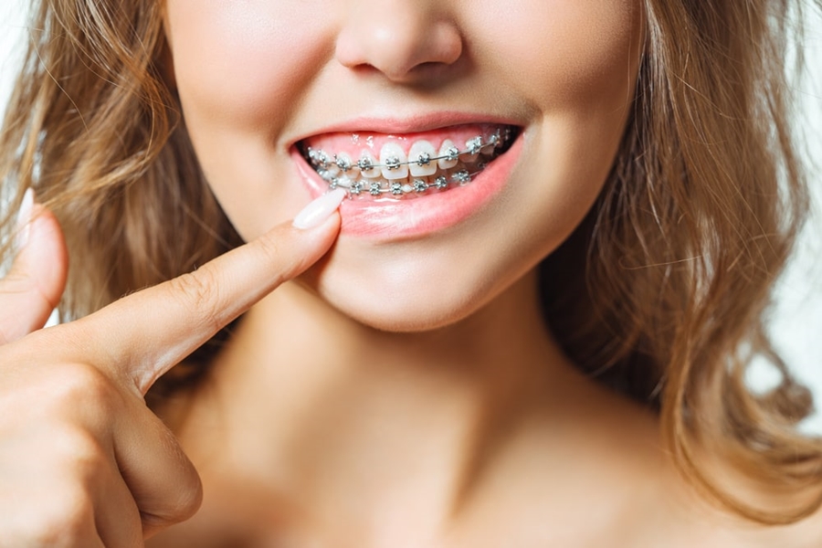 Types of braces available in the USA