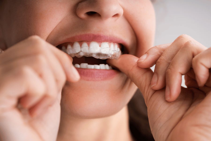 Invisalign cost in Alaska