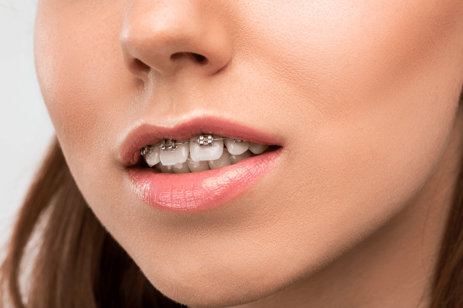 Fix overbite teeth