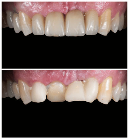 Teeth Straightening before and after