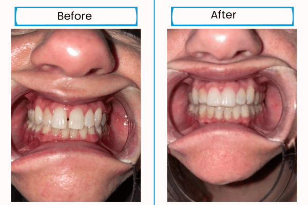 ALIGNERCO real before and after images.