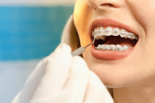 Lingual Braces for Teeth Straightening