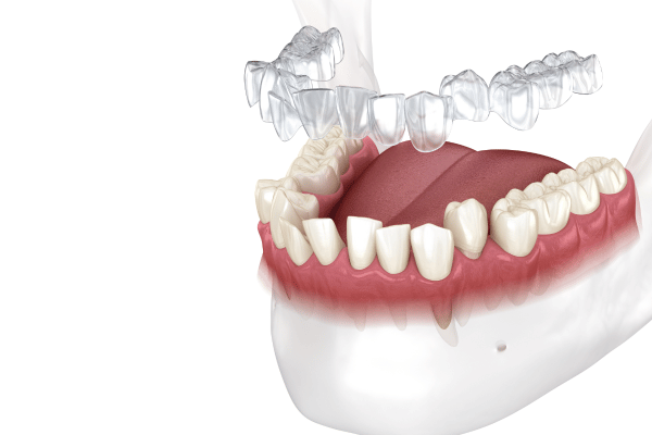 Clear aligners over teeth