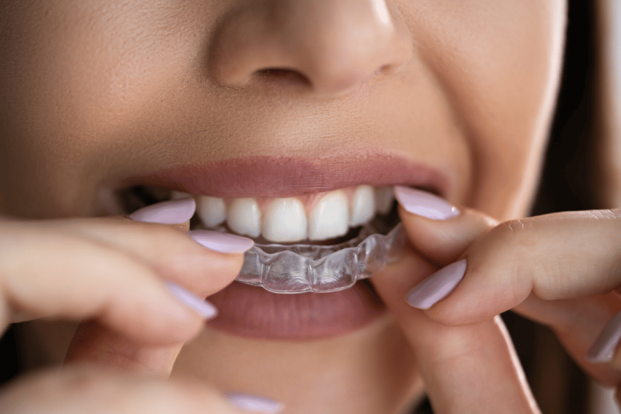 Clear Aligners Before and After