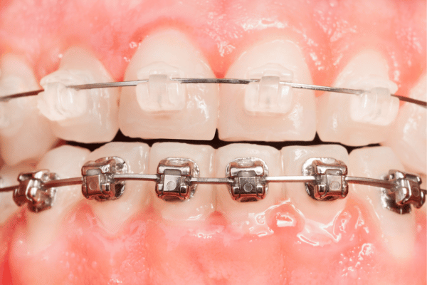 Ceramic vs metal braces