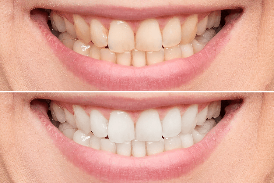 Teeth whitening before and after results