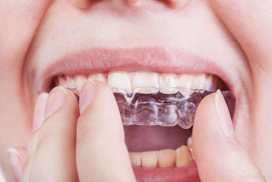 Close-up of woman wearing clear aligners