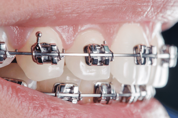 Metal Braces