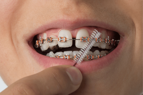 Brushing with braces