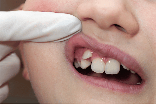 Malocclusion in children