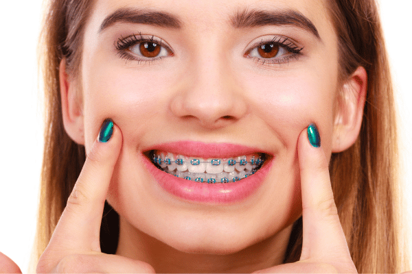 traditional braces