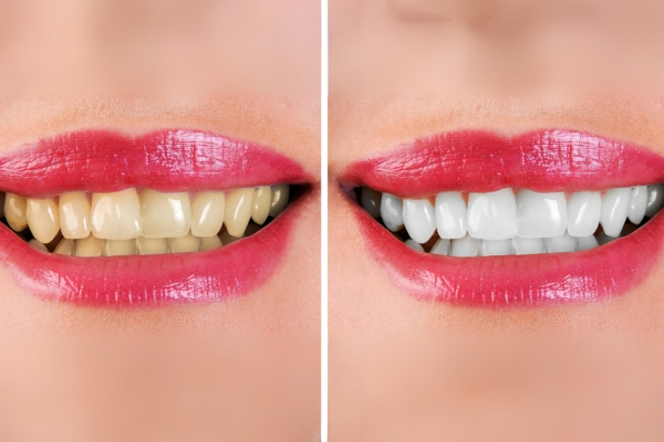 Teeth Whitening Before and After