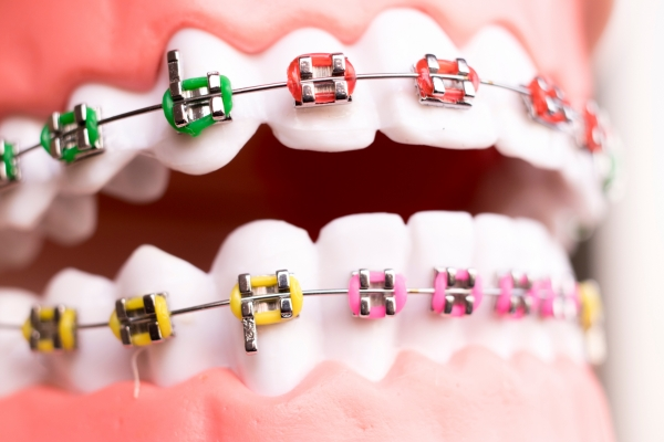 Traditional Metal Braces