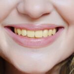 Worried About Your Smile? Does Vaping Stain Your Teeth? Discover How Teeth Whitening Works!