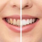 Find Out: Does Vaping Stain Your Teeth? How Teeth Whitening Can Help You!