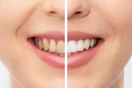 Stained Teeth Before and After