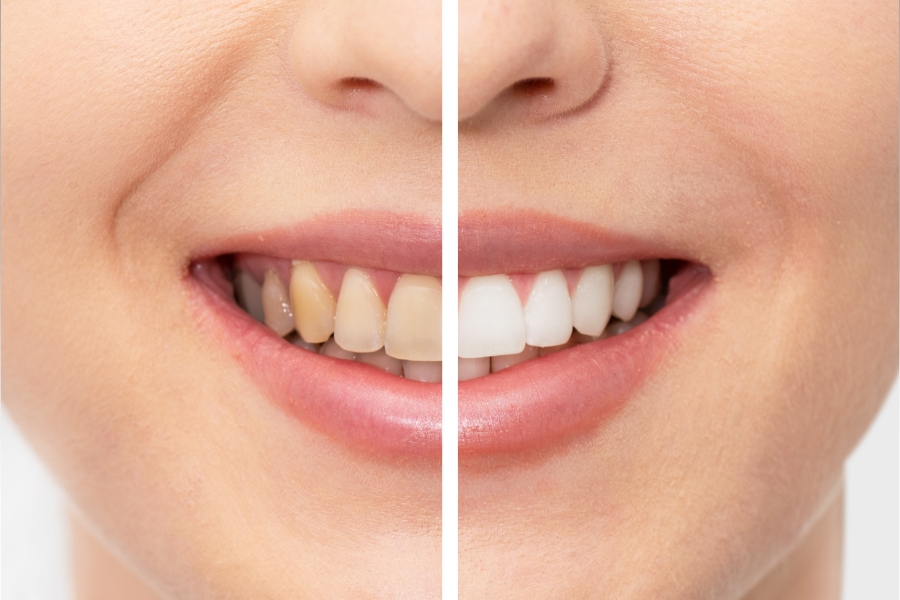 Stained Teeth Before and After