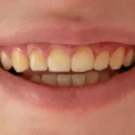 Discover How Vaping Affects Tooth Color and How Teeth Whitening Can Restore Your Smile