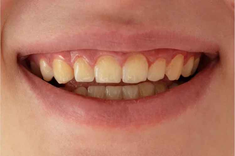 A person showing discolored teeth due to vaping