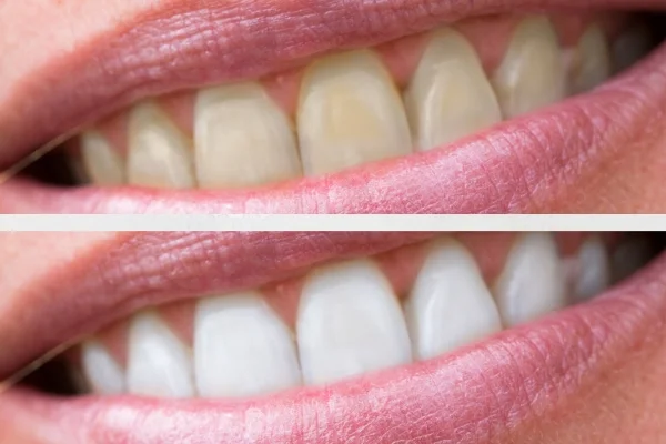 teeth discoloration