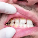 Why Are My Teeth Chipping? Causes and Treatment