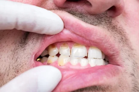 A close-up image of a person with chipped teeth