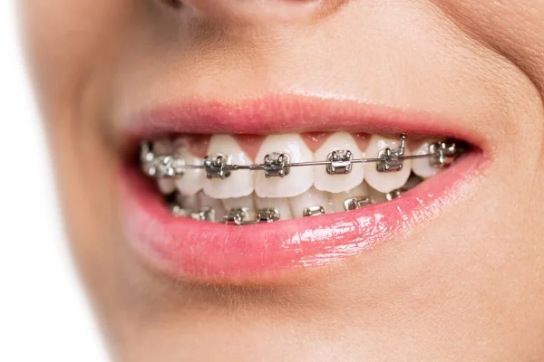 metal braces