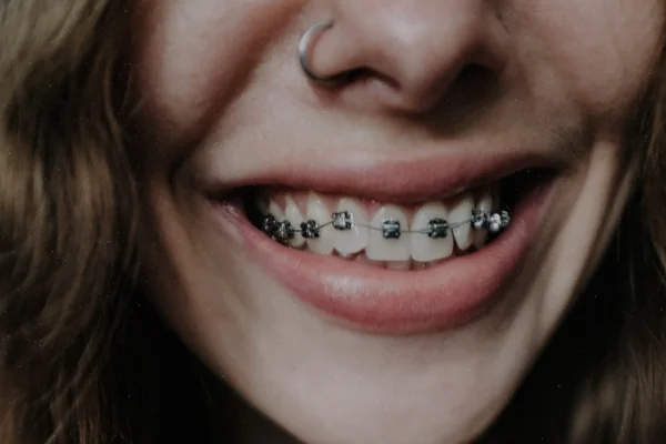 metal braces