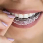 SmilePath vs. Byte: Which Clear Aligner Brand is Best?