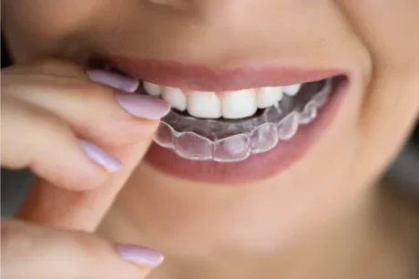 Clear aligners