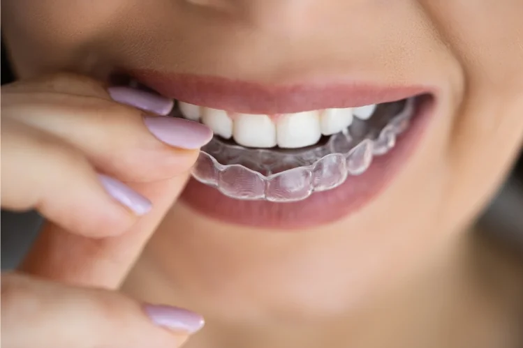 Clear aligners