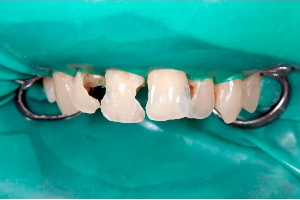 Cracked tooth before dental bonding