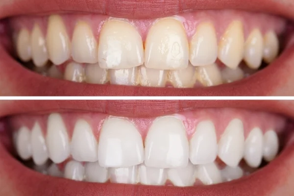 The before and after of discolored tooth in dental bonding