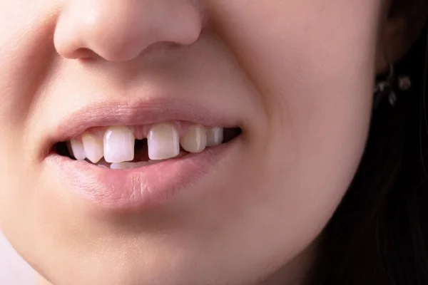 Close-up image of a woman with gap between the front teeth